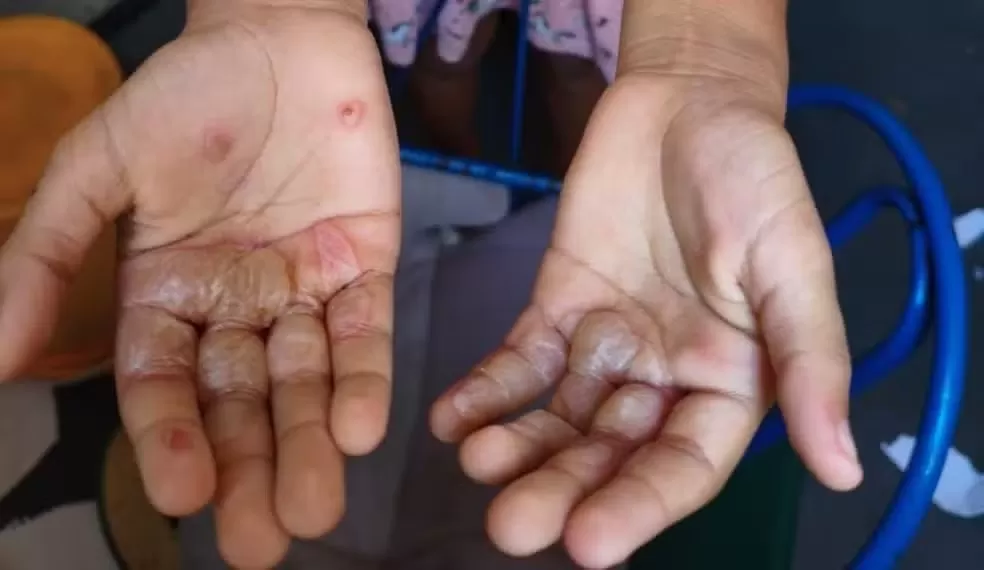 Mãe é presa por queimar mãos da própria filha como ‘punição’ em João Pessoa